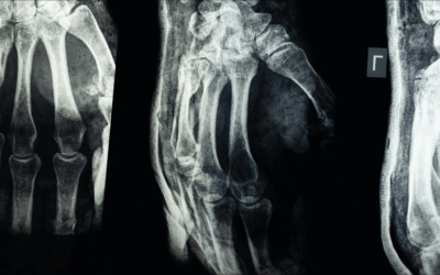 Steps to Take if Injured on Someone Else’s Property